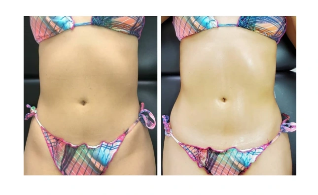 Fotografias reais do abdômen de uma cliente: antes à esquerda e depois à direita